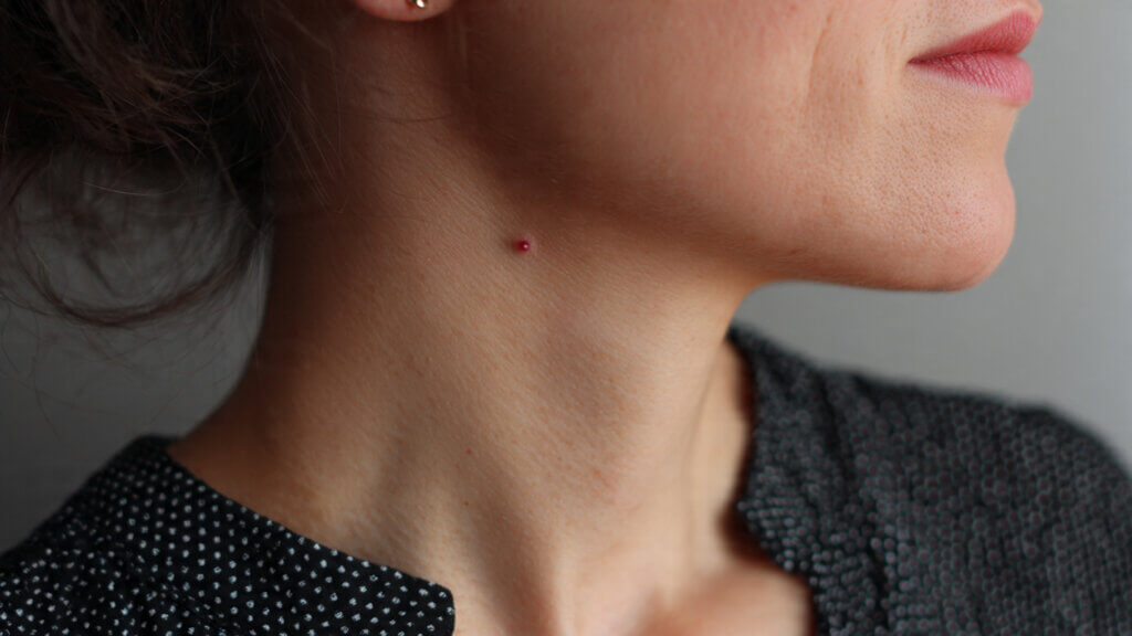 Mole on Right Side of Neck Female